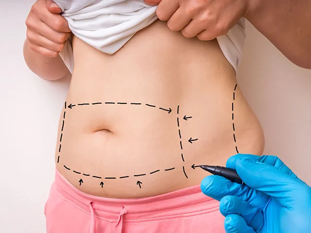 Karın Germe Estetiği (Abdominoplasti)