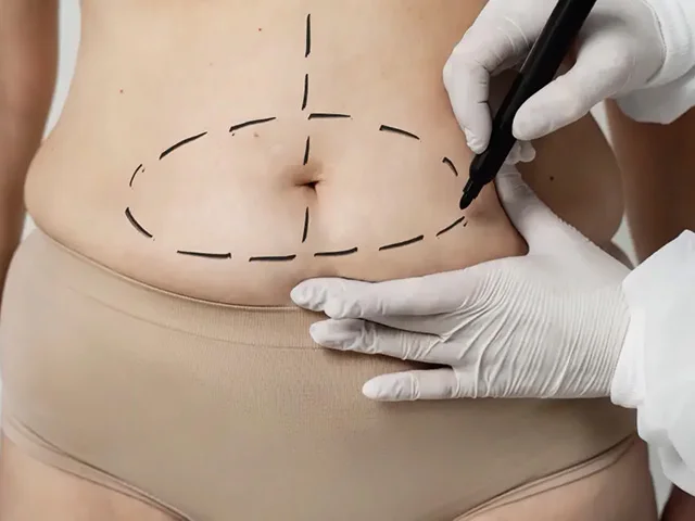 Liposuction (Yağ Alma Ameliyatı)